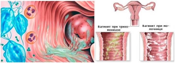 Лечение кольпита (вагинита) у женщин: препараты, антибиотики, свечи, восстановление микрофлоры