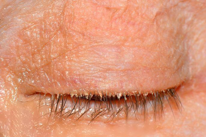 Симптомы и корректное лечение демодекса глаз у человека