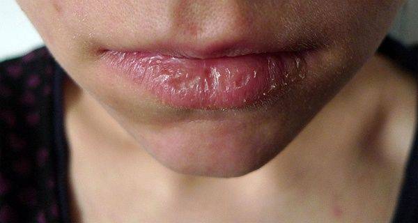 Трескаются губы – каких витаминов не хватает