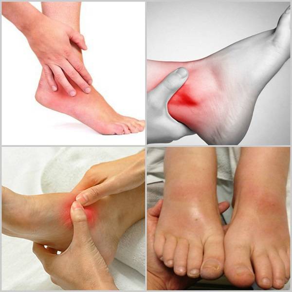 Боль в ногах (боль в нижних конечностях, болят ноги) - симптомы и лечение. журнал медикал