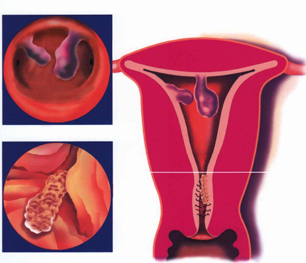 Когда можно беременеть после удаления полипа в матке методом выскабливания, гистрескопии
