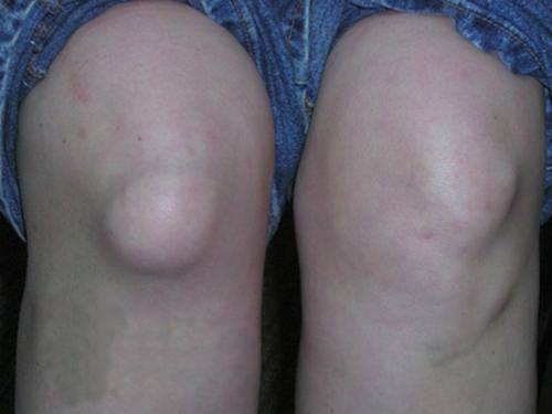 Супрапателлярный бурсит коленного сустава и что это за патология
