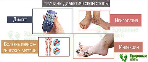 Симптомы и лечение диабетической стопы, уход за ногами при диабете