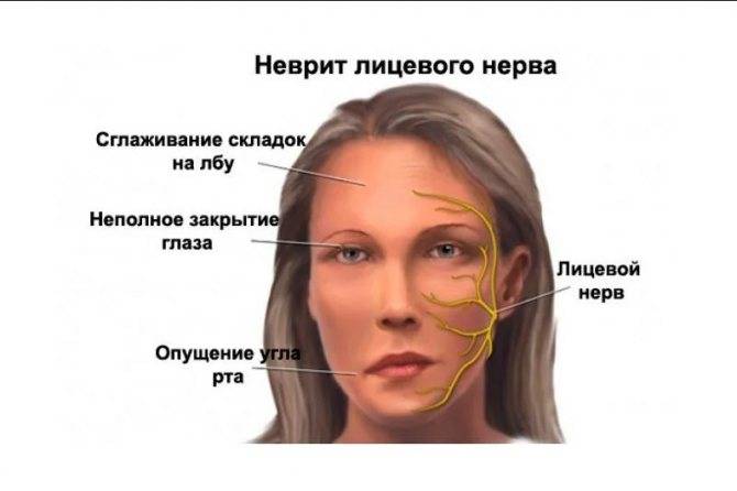 Невралгия лицевого нерва: причины, симптомы и лечение
