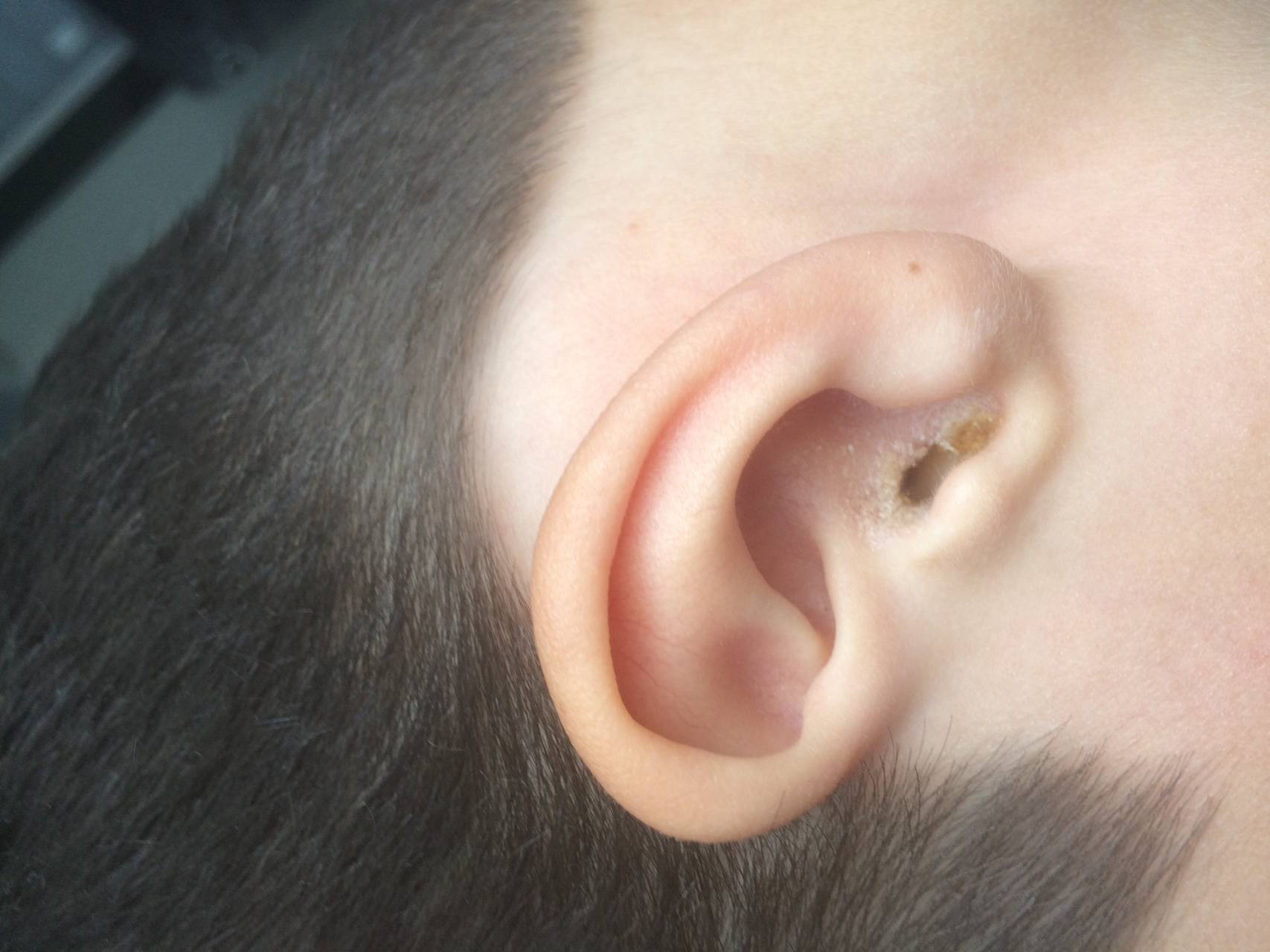 Серная пробка в ухе: симптомы, удаление в домашних условиях