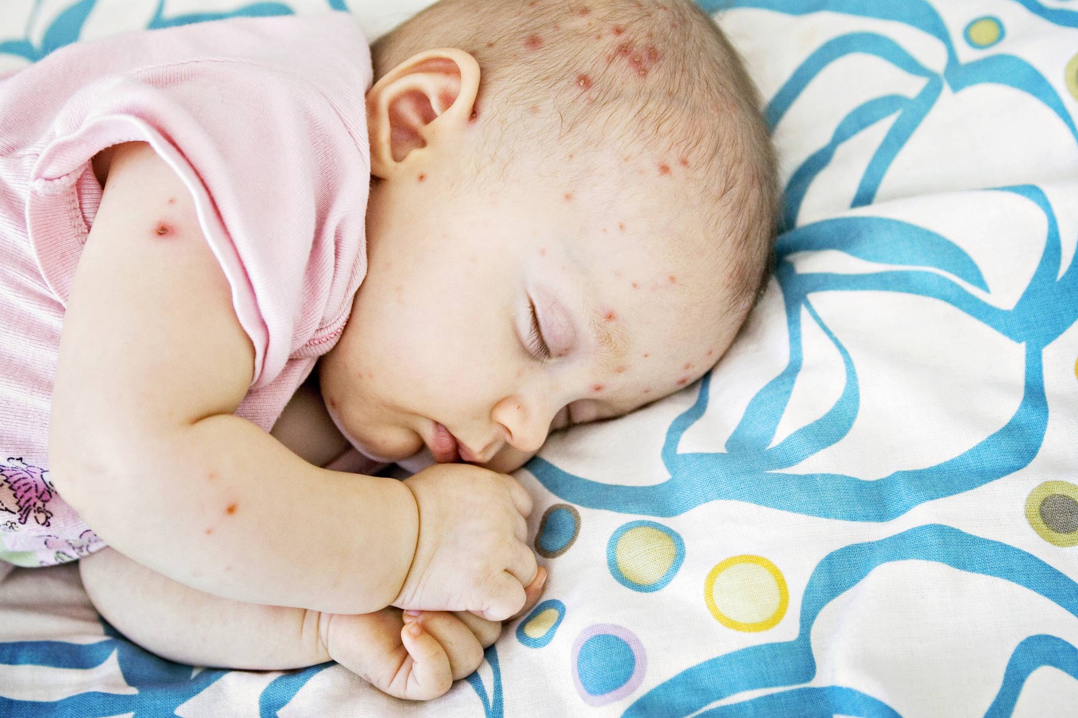 Комаровский - чем лечить вирусную пузырчатку у детей: фото, симптомы, лечение