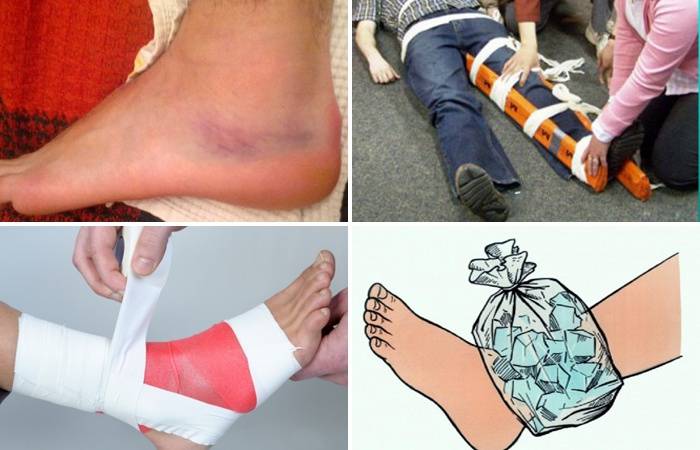 Перелом пальцев ноги (первая помощь, гипс, реабилитация)