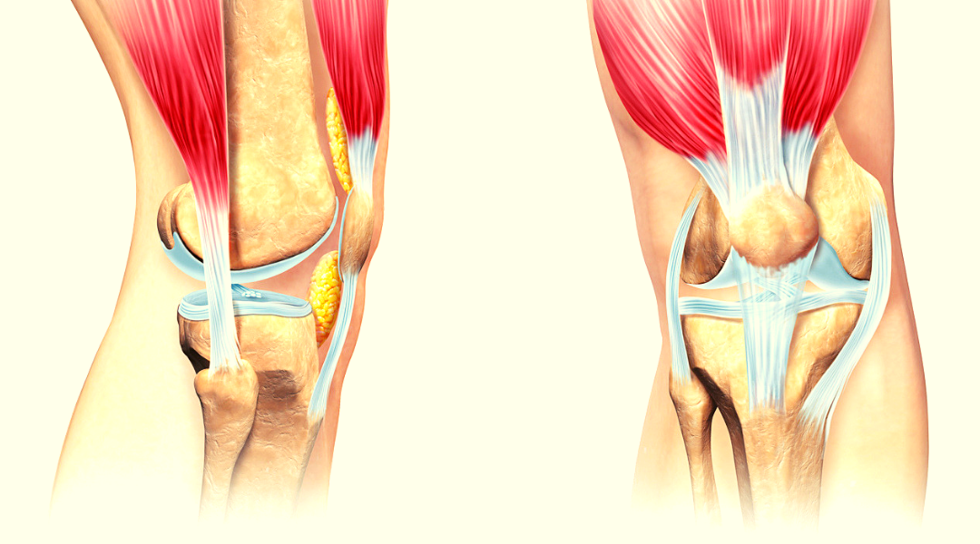 Симптомы крестообразной связки коленного сустава. Тендинит сухожилия коленного сустава. Полусухожильная мышца коленного сустава. Крестообразные связки коленного сустава анатомия. Тендинит связки коленного сустава.