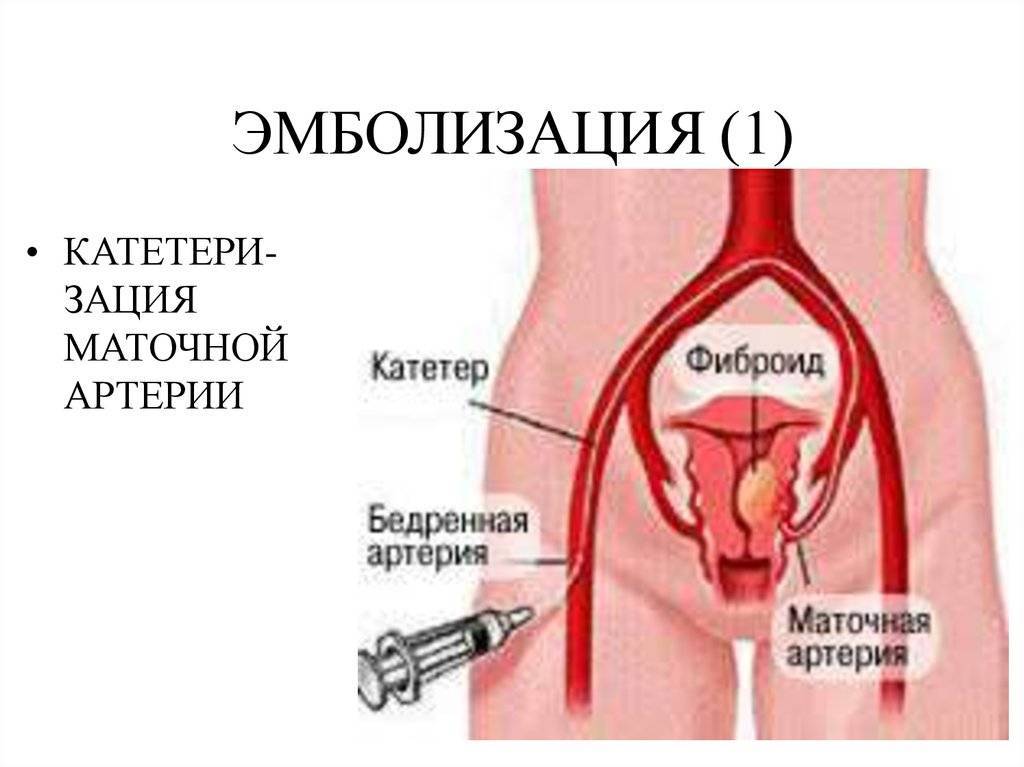 Эмболизация миомы матки: суть, лечение, противопоказания и осложнения