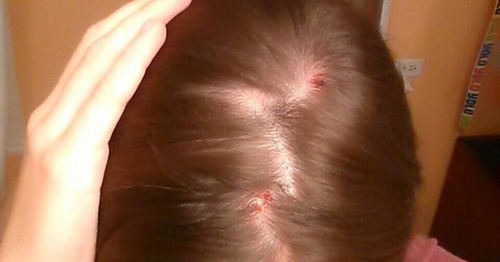Прыщи на голове в волосах - причины появления, способы лечения
