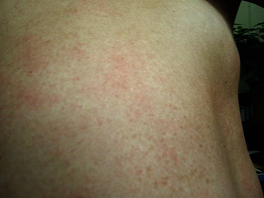 Сыпь на теле у взрослого: как лечить, если чешется, красные высыпания по всему телу и аллергия