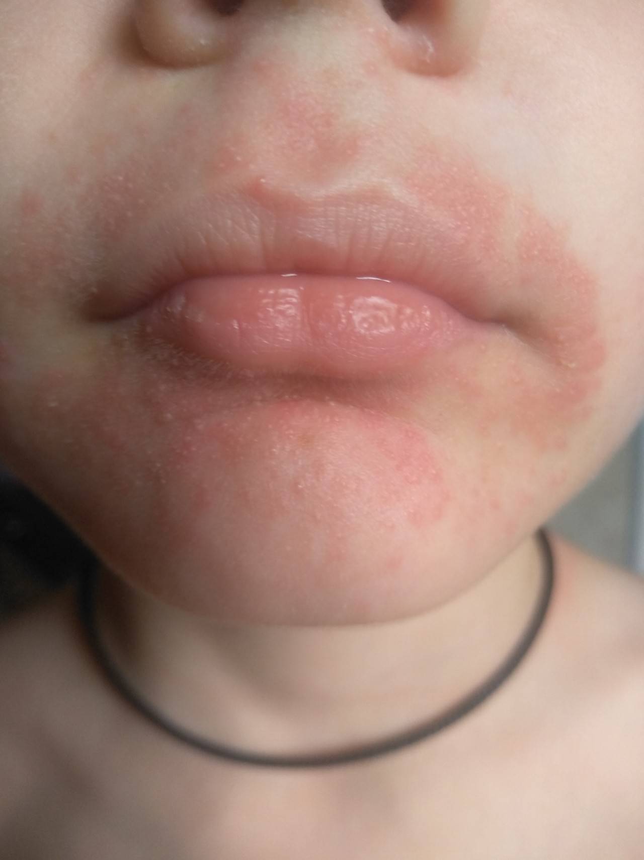 Краснота вокруг носа - причины шелушения и как лечить