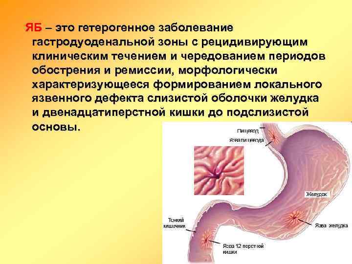 Симптомы гастрита и язвы желудка. лечение народными средствами | wmj.ru