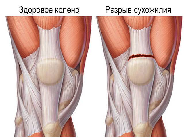 Боль коленной связки. Тендинит сухожилия подколенной мышцы. Сухожилие надколенника анатомия. Тендиноз сухожилия коленного сустава. Тендинопатия сухожилия коленного сустава.