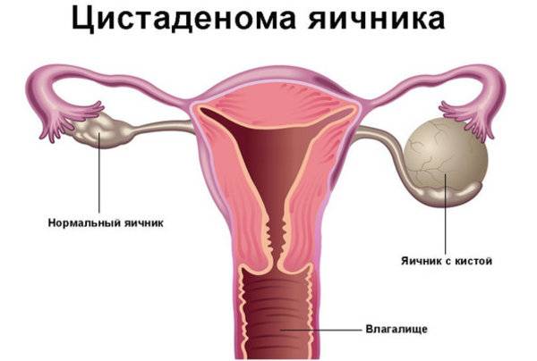 Овариальный резерв яичников — запас яйцеклеток ограничен * клиника диана
