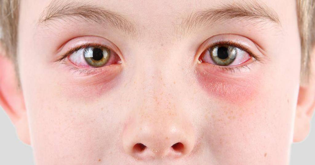 Аллергия на глазах: чем лечить, причины аллергической реакции, первые признаки и симптомы
