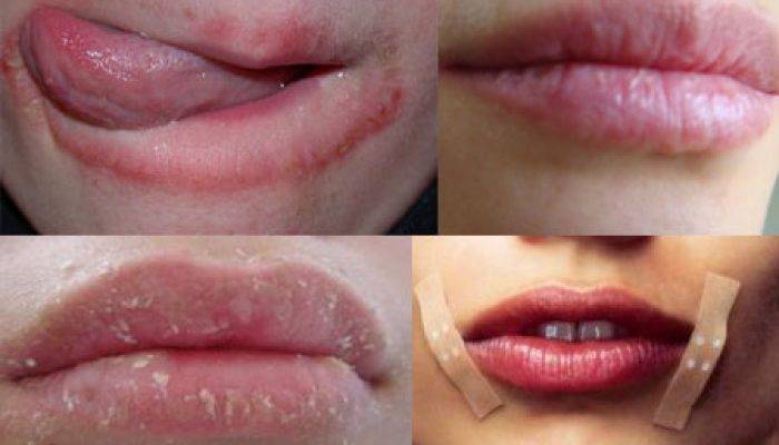 8 неожиданных причин, почему ваши губы сухие и потрескавшиеся
