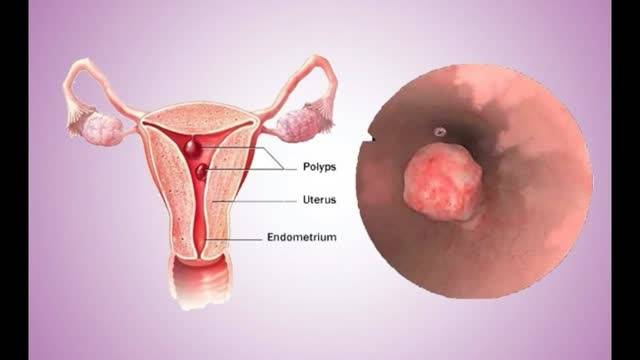 Фиброзный полип эндометрия