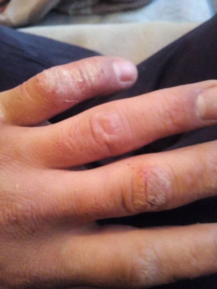 Раздражение, покраснение между пальцами рук: причины, чем лечить