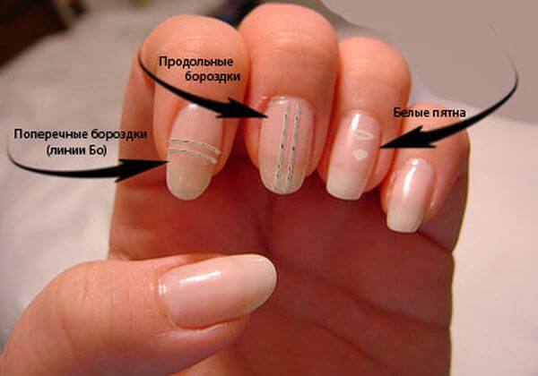 Почему появляются продольные и поперечные полосы на ногтях