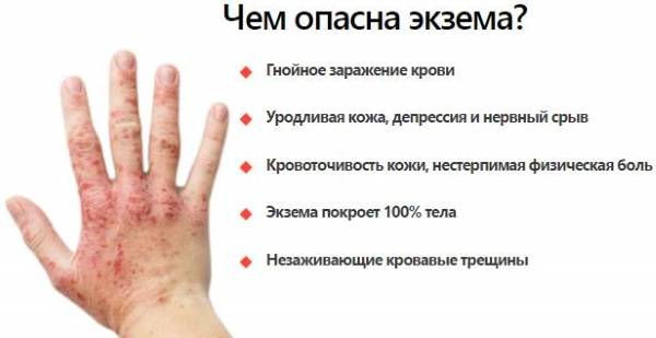Как вылечить цыпки на руках? :: syl.ru