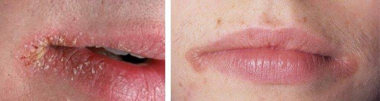 Трещины в уголках губ причины и лечение недуга