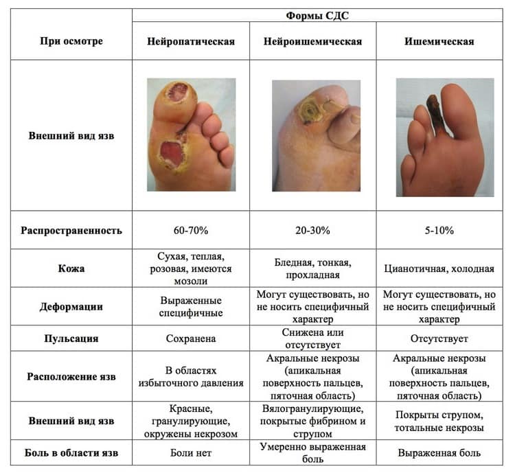 Стопы ног при сахарном диабете - медицинский портал diabetiku24.ru