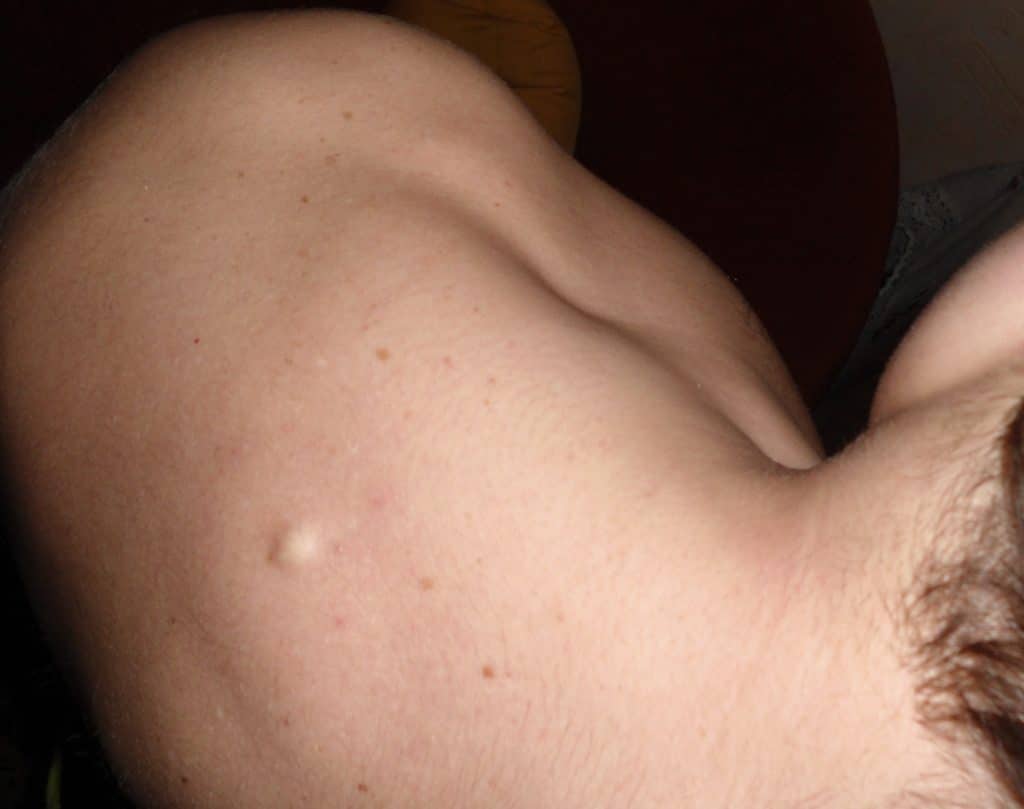 уплотнение под кожей на груди у мужчин фото 10