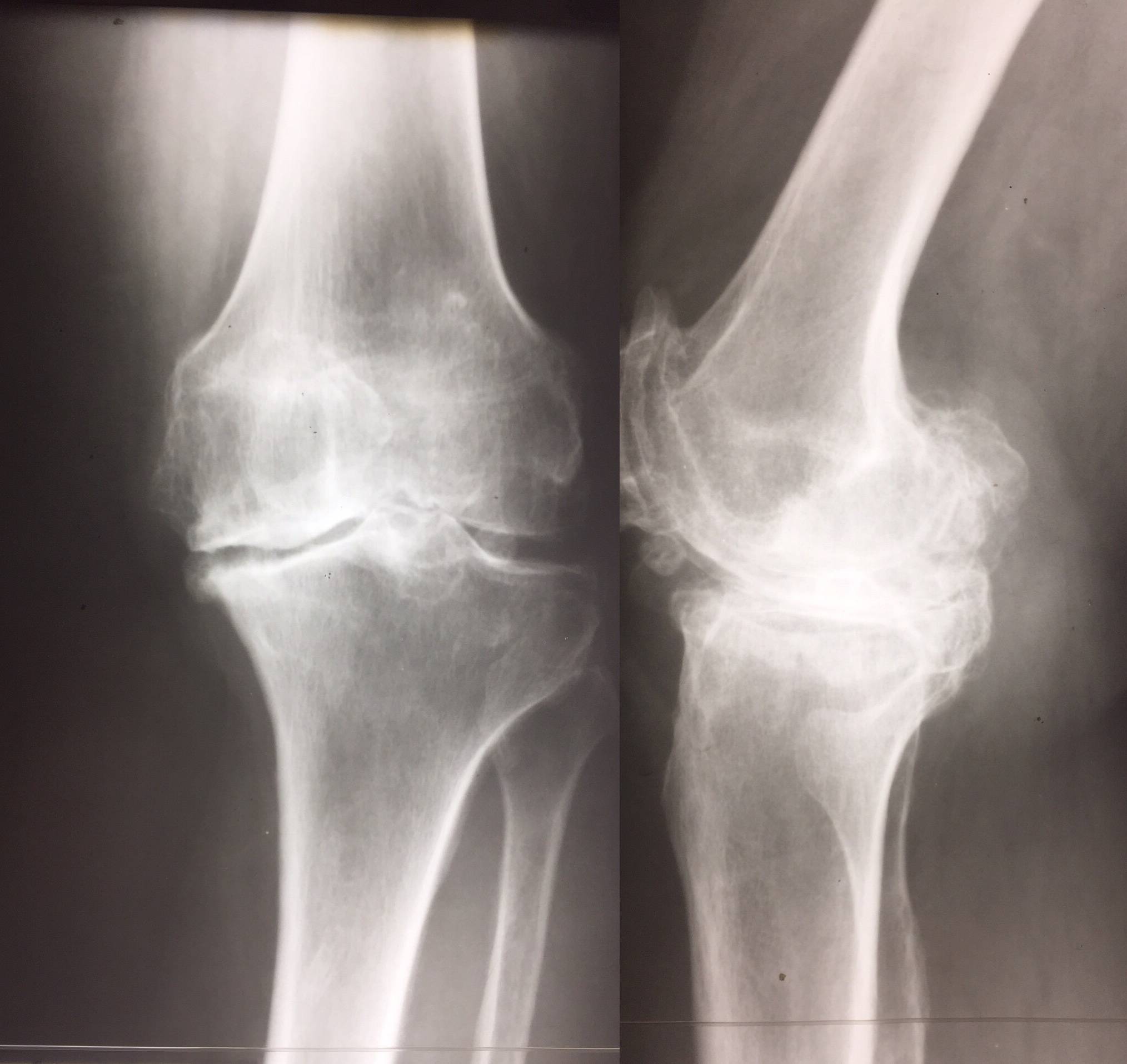 Остеоартроз это. Доа коленного сустава на рентгене. Гонартроз коленного сустава. Гонартроз 2 степени рентген. Гонартроз 2 степени коленного сустава рентген.