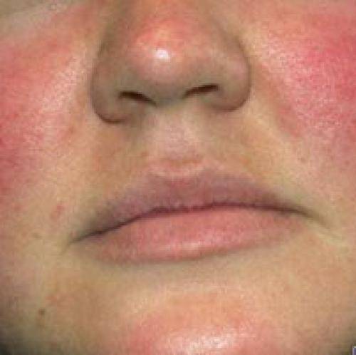 Покраснения на лице: причины, методы лечения красноты