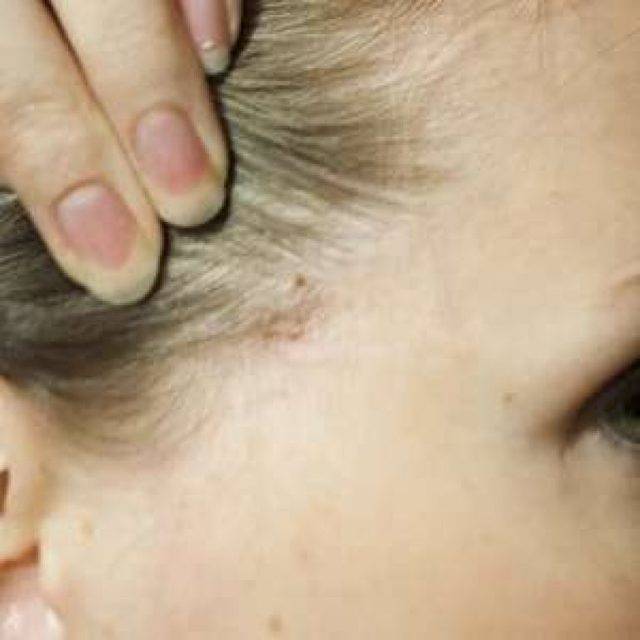 Прыщи на голове в волосах: причины появления и лечение у женщин и мужчин