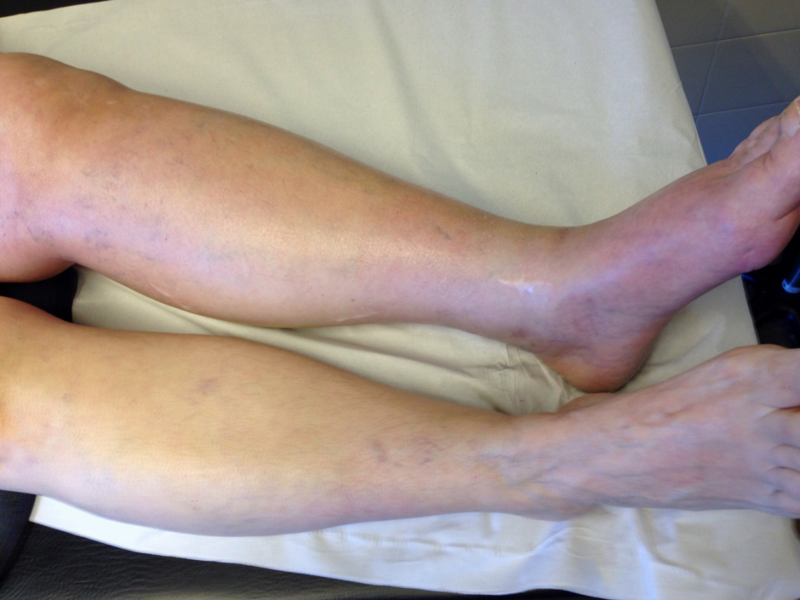 Тромбофлебит нижних конечностей - лечение тромбофлебита ног