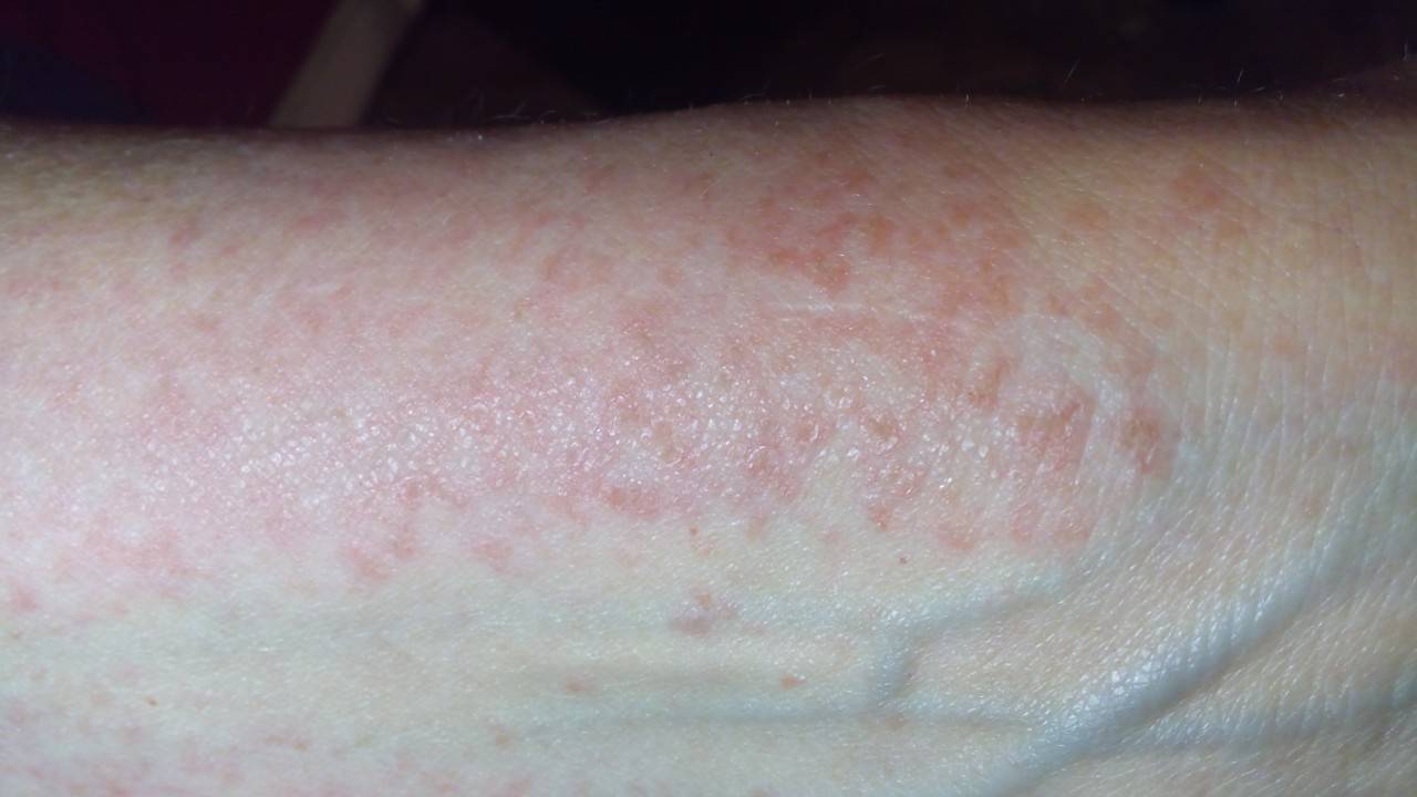 Виды аллергической сыпи (пятен) на коже — как выглядит, чем лечить ( фото)