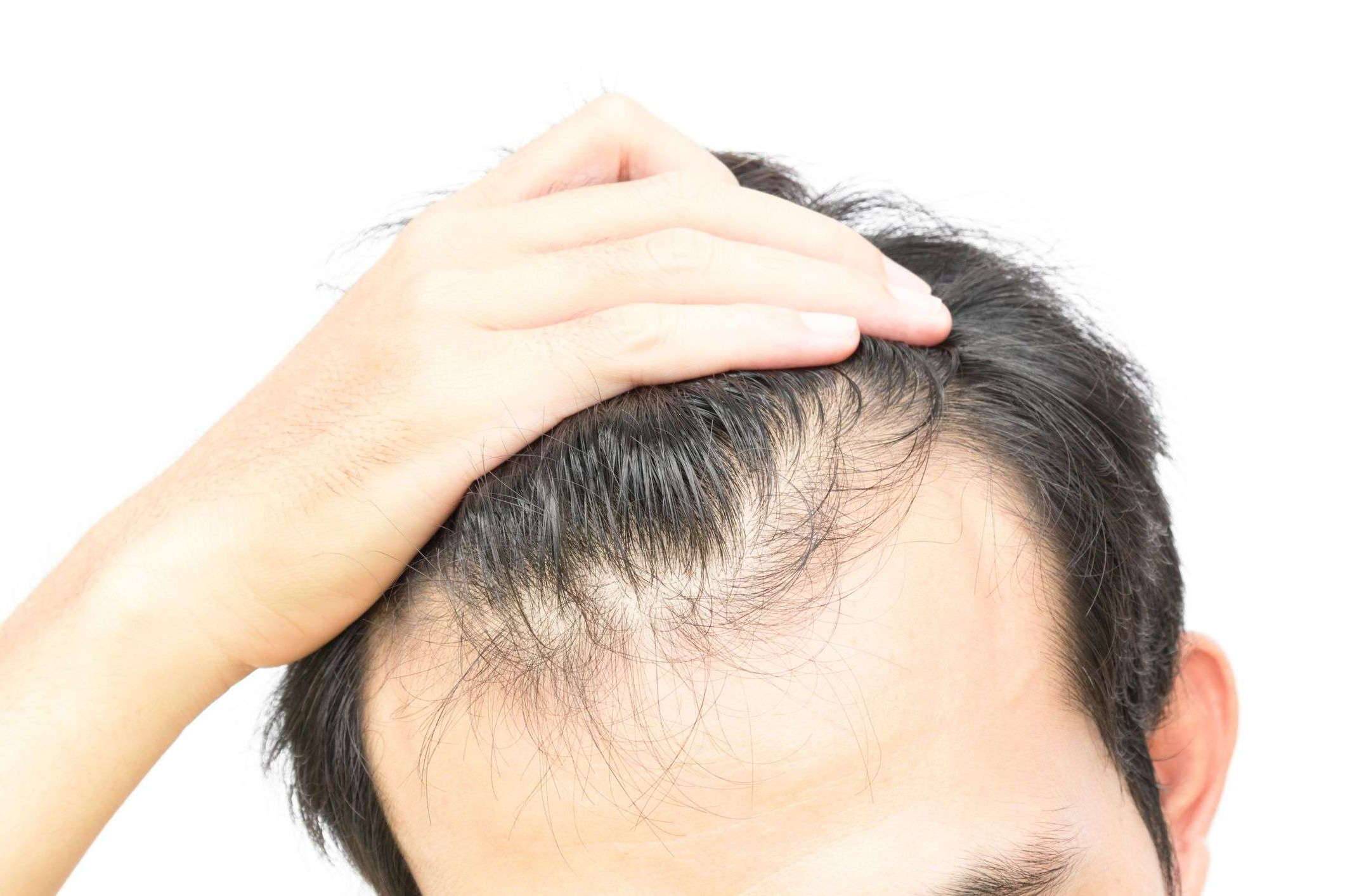 Зуд головы и выпадение волос причины. Андрогенная алопеция Гамильтон. Поредение волос у мужчин.