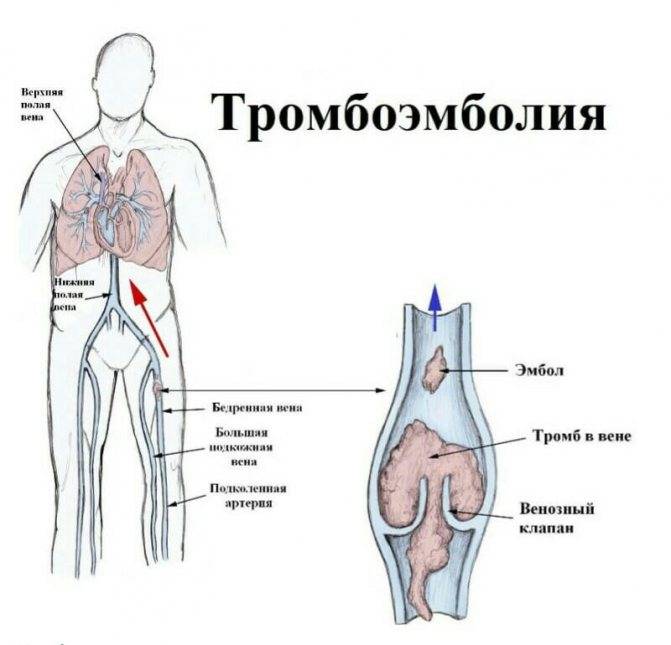 Тромбоэмболия. симптомы и признаки, прогноз для жизни, диагностика, лечение, профилактика
