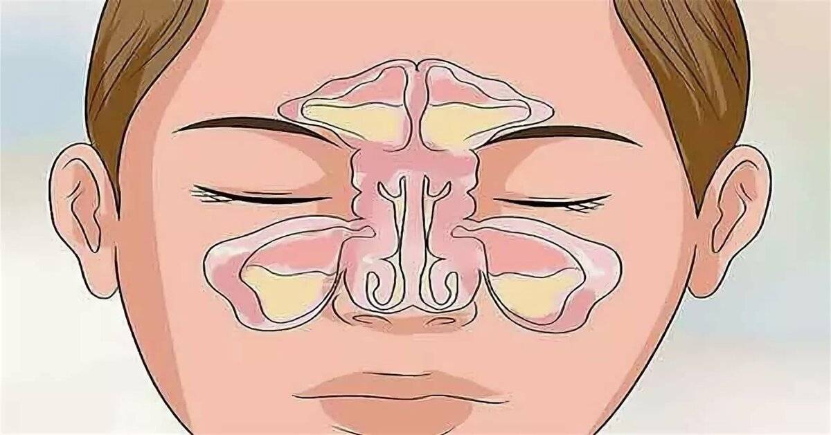 Болячки в носу: причины появления, виды, способы лечения