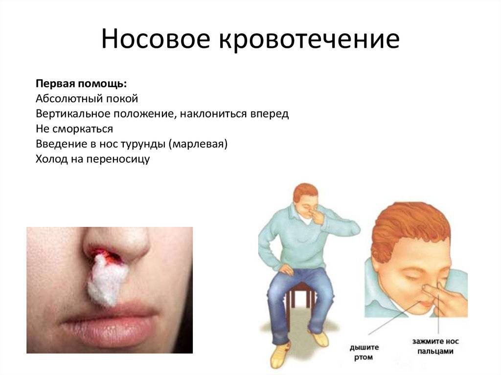 11 причин, почему течет кровь из носа у взрослого | lisa.ru