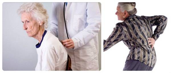 Симптомы остеопороза у женщин после 50 лет. Остеопороз климактерический. Остеопороз у женщин. Остеопороз у пожилых. Остеопороз у пожилых симптомы.