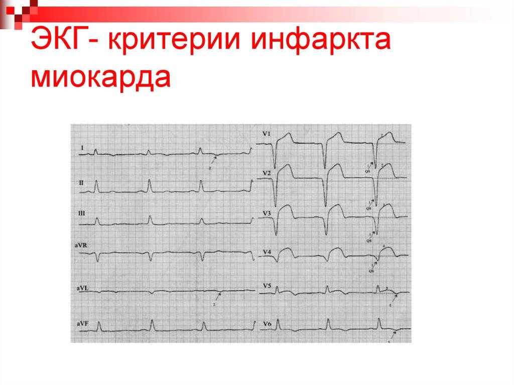 Покажет ли кардиограмма предынфарктное состояние