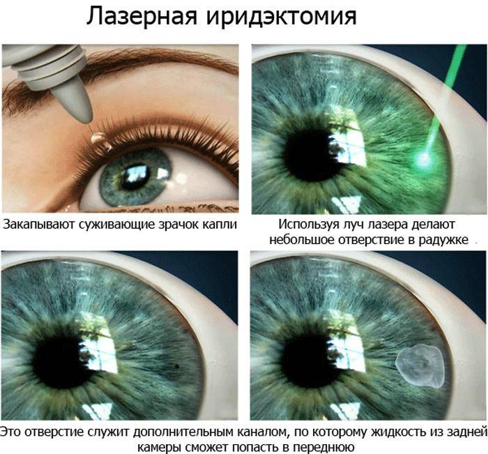 Лазерная иридэктомия: преимущества и недостатки - "здоровое око"