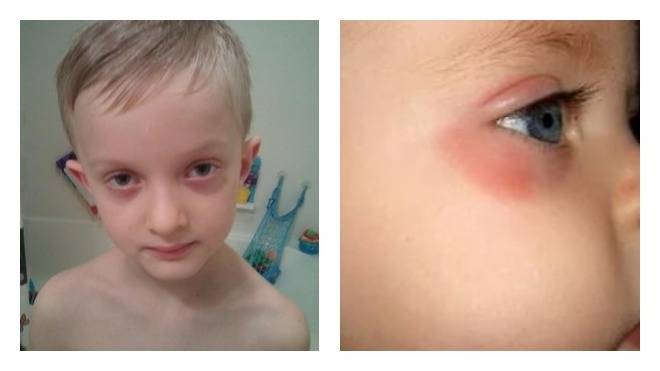 Предвещают ли подобные симптомы беду: почему у ребенка красные глаза без гноя?