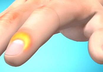 Панариций пальца — лечение и фото