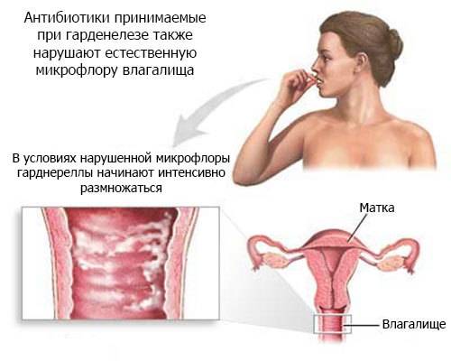 Гарднереллез при беременности: причины, симптомы, диагностика и лечение