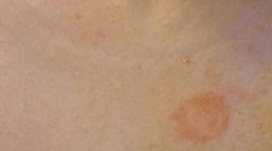 Пятна на коже с красным ободком - фото, причины, лечение