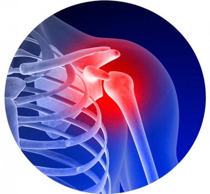 Лечение остеоартроза 2 степени плечевого сустава. степени