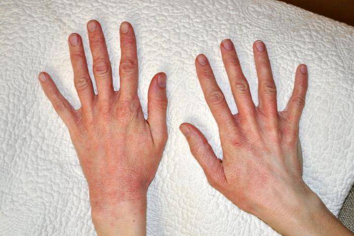 Дерматит - 64 фото как выглядит распространенное заболевание кожи