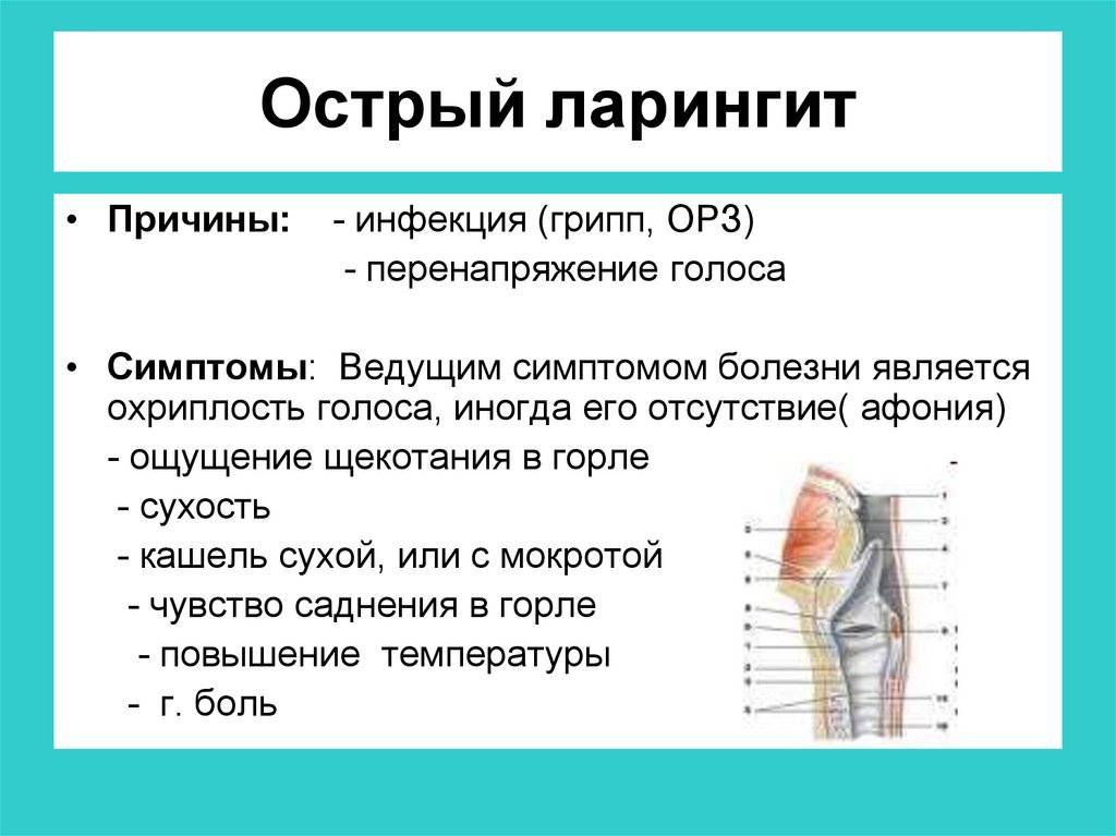 Острый ларингит схема лечения