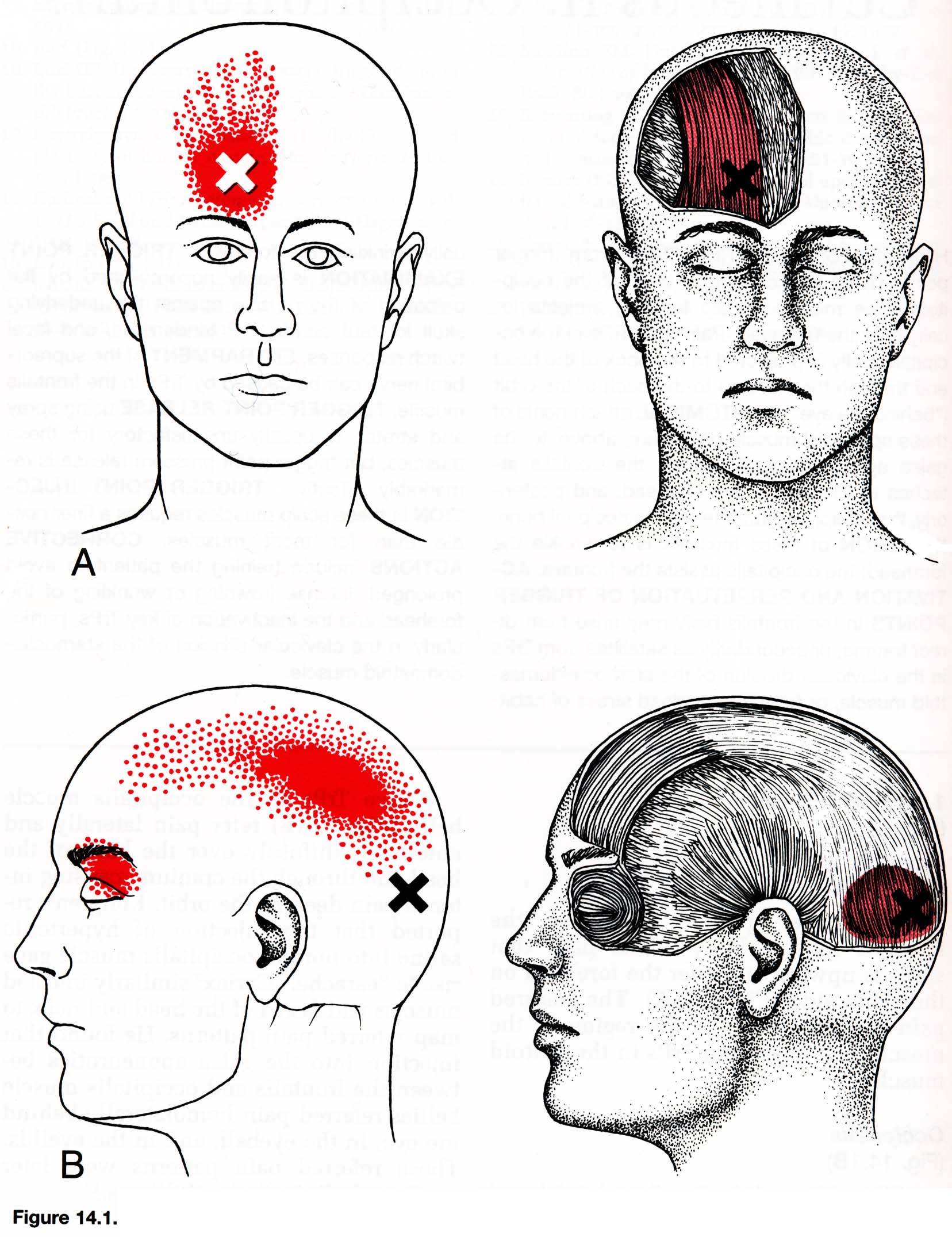 Болит голова в затылке и висках: причины, первичные и вторичные боли, лечение