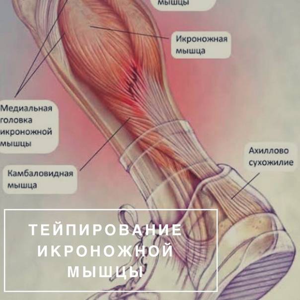 Повреждение икроножной мышцы симптомы лечение