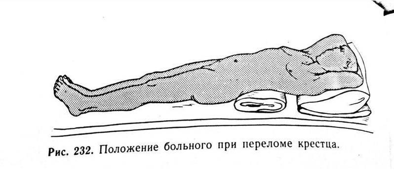 Перелом крестца без смещения: как долго заживает, лечение и последствия
